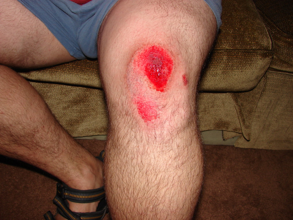 road rash on knee